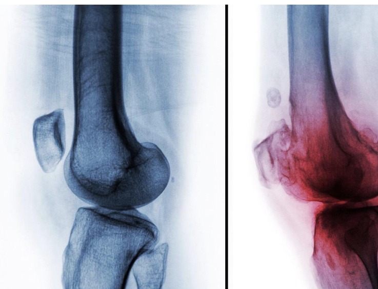 Early signs of knee arthritis and knee pain treatment in Bangalore
